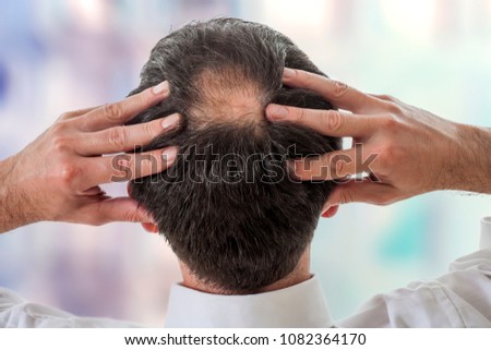 male head with thinning hair or alopecia Royalty-Free Stock Photo #1082364170