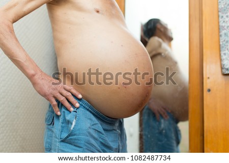 ascites in a person standing next to a mirror Royalty-Free Stock Photo #1082487734