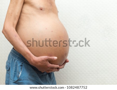 ascitic disease in man Royalty-Free Stock Photo #1082487752