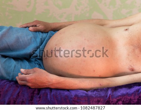 ascites in humans, lies in bed Royalty-Free Stock Photo #1082487827