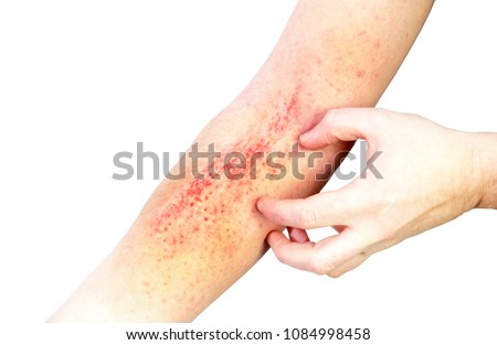 Atopic dermatitis (AD), also known as atopic eczema, is a type of inflammation of the skin (dermatitis) at foot. Royalty-Free Stock Photo #1084998458