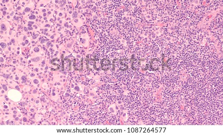 Breast Cancer; lymph node metastasis: Microscopic image of cross section of a  "sentinel" axillary lymph node with invasion by metastatic infiltrating ductal carcinoma (tumor cells left).    Royalty-Free Stock Photo #1087264577