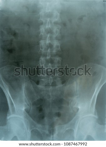X-ray picture of the spine and pelvis of an old man with back and abdominal pain