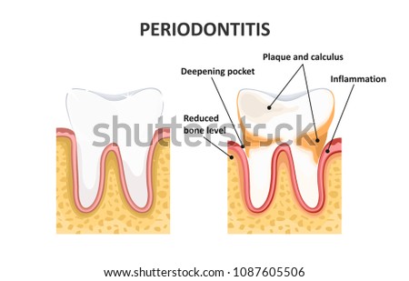 Periodontitis, dental disease. Inflammation of the gums