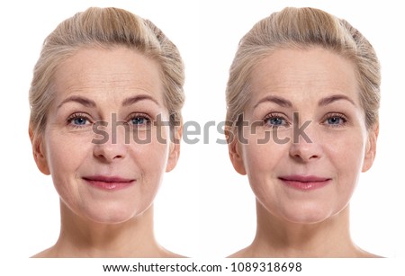 Woman face before and after cosmetic procedure. Plastic surgery concept. Royalty-Free Stock Photo #1089318698