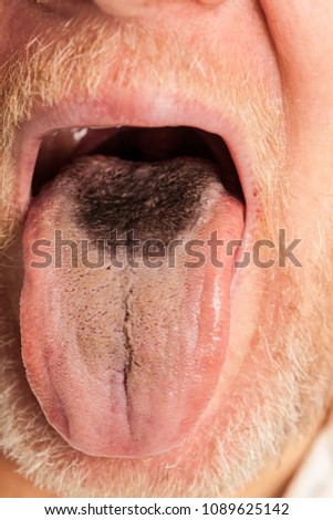 Male showing black hairy tongue closeup. Health problem, oral hygiene.