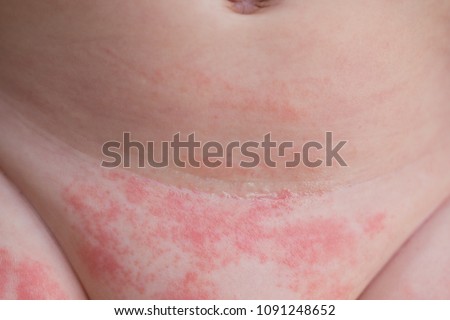 Yeast diaper rash and dermatitis on the belly of a newborn baby  Royalty-Free Stock Photo #1091248652