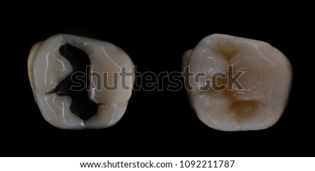 amalgam filling replacement with composite Royalty-Free Stock Photo #1092211787