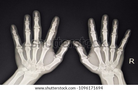 film x-ray both hand AP : show normal human's hands on black background 