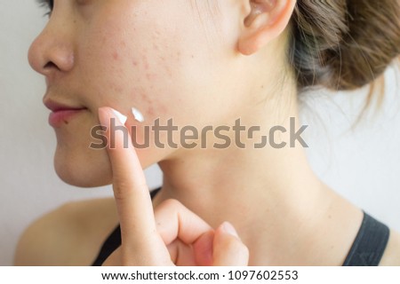 Portrait of young Asian woman having acne problem and she applying acne cream on her face. Royalty-Free Stock Photo #1097602553