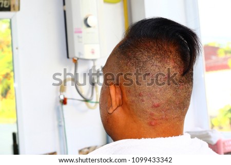 Skin diseases of the head in the sabon mushy Thailand.