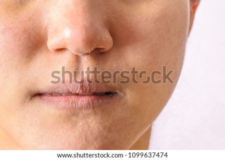 Allergic women have eczema dry nose and lips on winter season closeup. Royalty-Free Stock Photo #1099637474