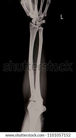  film x-ray lift forearm AP                              