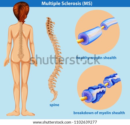 An Education Poster of Sclerosis illustration
