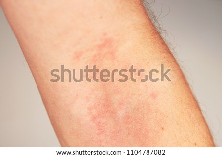 atopic dermatitis arm detail