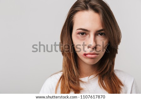 Portrait of a disabled young girl with scratches and bruises on her face looking camera. Royalty-Free Stock Photo #1107617870