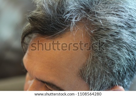 Pictures of scalp conditions,hair loss and male pattern baldness in middle age of men,male pattern baldness develop a bald spot or hairline that recedes to form an “M”shape.Grey hair and scalp decease