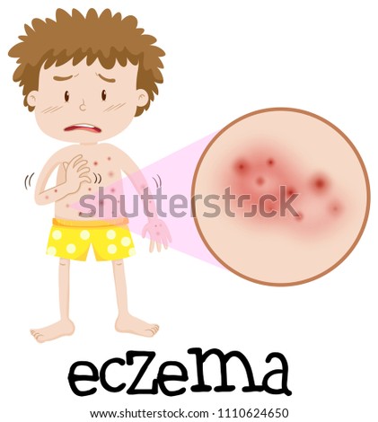 Young boy with magnified eczema illustration