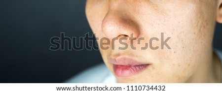 Acne pimples scar on face skin issues, close up Royalty-Free Stock Photo #1110734432