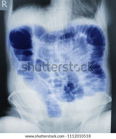 Small bowel obstruction. Film X-ray abdomen upright : show small bowel dilated and air-fluid level in small bowel due to small bowel obstruction with mark area with blue color