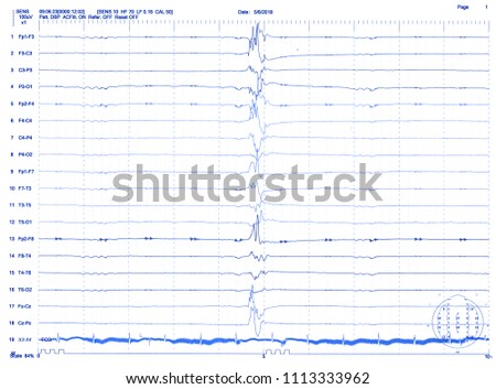 Abnormal brain wave in human EEG of the patients problems in the electrical activity of the brain.Abnormal EEG.