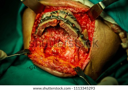 Patient during  surgery to jaw bone treatment in operating room at hospital.