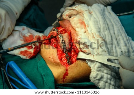Patient during  surgery to jaw bone treatment in operating room at hospital.