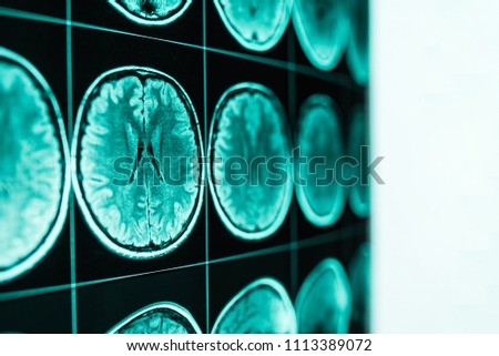 X-ray of the head and brain, MRI, in defocus
