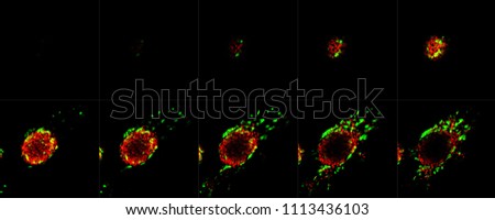 Cancer tumour cells. A montage of microscope research images.