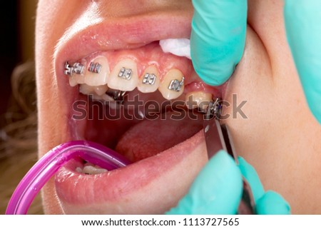 Close up picture of young female's mouth. Dental braces - treatment