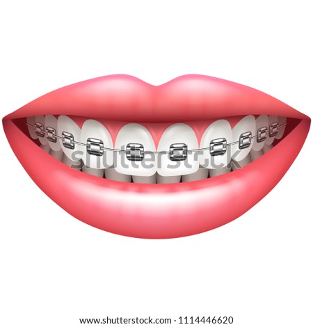 Teeth with braces beautiful woman smile isolated on white vector illustration