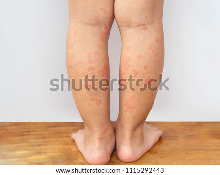 Child with symptoms of itchy urticaria at legs. Royalty-Free Stock Photo #1115292443