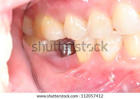 single tooth implant Royalty-Free Stock Photo #112057412