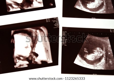 2D and 4D picture of ultrasound baby.