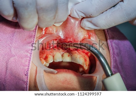 Root canal, mouth ulcer and toothache.