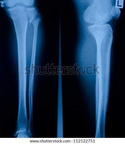 X-ray film of proximal tibia and intra articular fracture