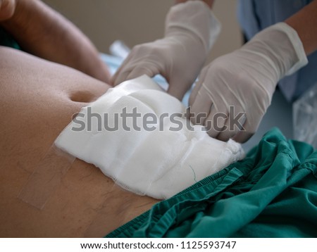 Wound is dressed to keep it clean and free from postoperative infection of appendicitis Royalty-Free Stock Photo #1125593747
