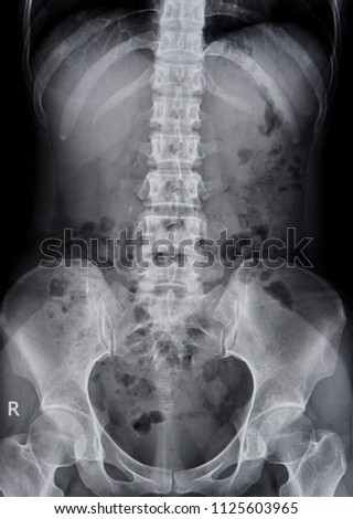 X-ray image of plain KUB (kidney, ureter and bladder), Abdomen                                