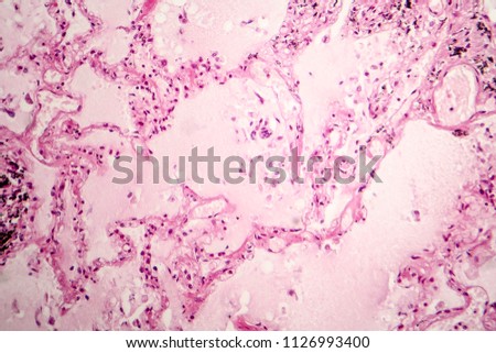 Histopathology of acute pulmonary edema, light micrograph showing accumulation of fluid inside alveoli Royalty-Free Stock Photo #1126993400