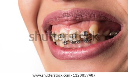 orthodontic treatment begins 
