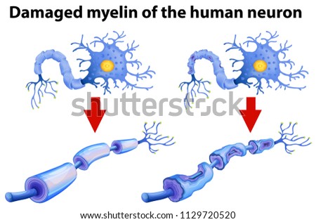 Dammaged Myelin of the Human Neuron illustration
