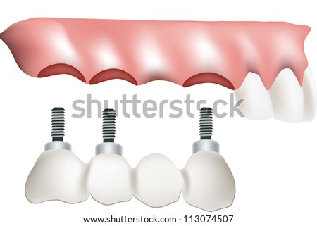 dental bridge Royalty-Free Stock Photo #113074507