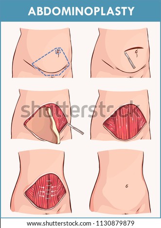 Abdominoplasty and Lipectomy Procedures Royalty-Free Stock Photo #1130879879