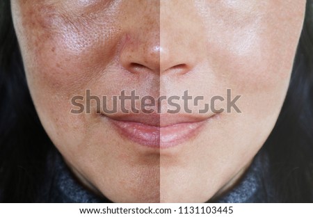Face with open pores and melasma before and after make up or treatment concept. Royalty-Free Stock Photo #1131103445