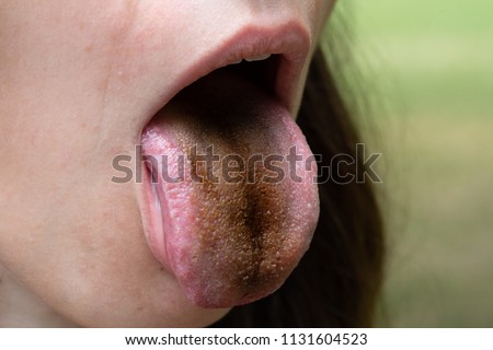 Girl with black tongue due to Enterobacter cloacae