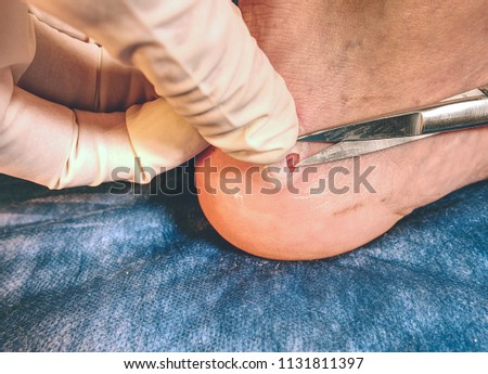 Surgeon cuts the patients dead skin with sterile scissors. Cleaning of hurt heel with horrible abrasive place and cracked wet blister