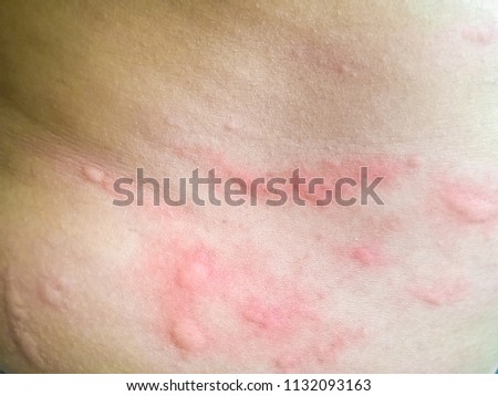 Healthcare Picture background of congenital disorder of thai or asian people,Closeup image of symptoms of itchy urticaria or rash on on the stomach with Selective Focus.