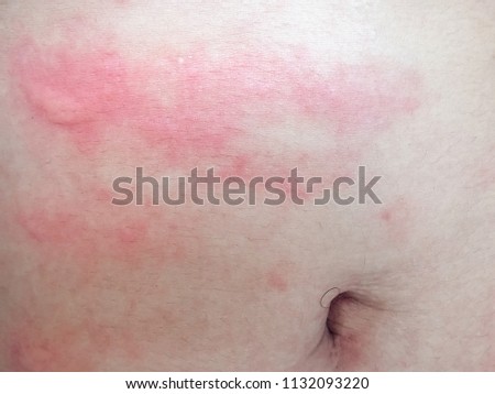 Healthcare Picture background of congenital disorder of thai or asian people,Closeup image of symptoms of itchy urticaria or rash on on the stomach with Selective Focus.