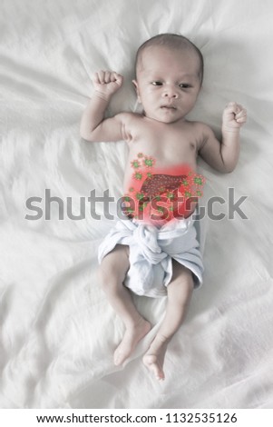Asian born Little Baby on white cotton.Sick baby, pale picture and Red circle showing sickness
( liver)
