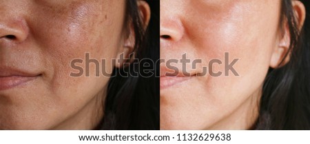 Before and after facial treatment concept. Face with melasma and brown spots and open pores.  Royalty-Free Stock Photo #1132629638